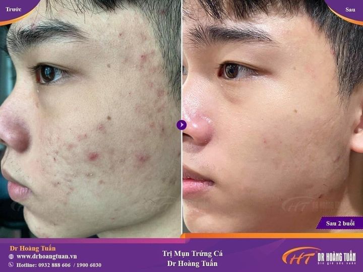 trị mụn giá bao nhiêu